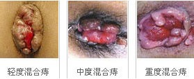 混合痔症状、治疗费用