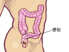 大便拉不出来怎么办？